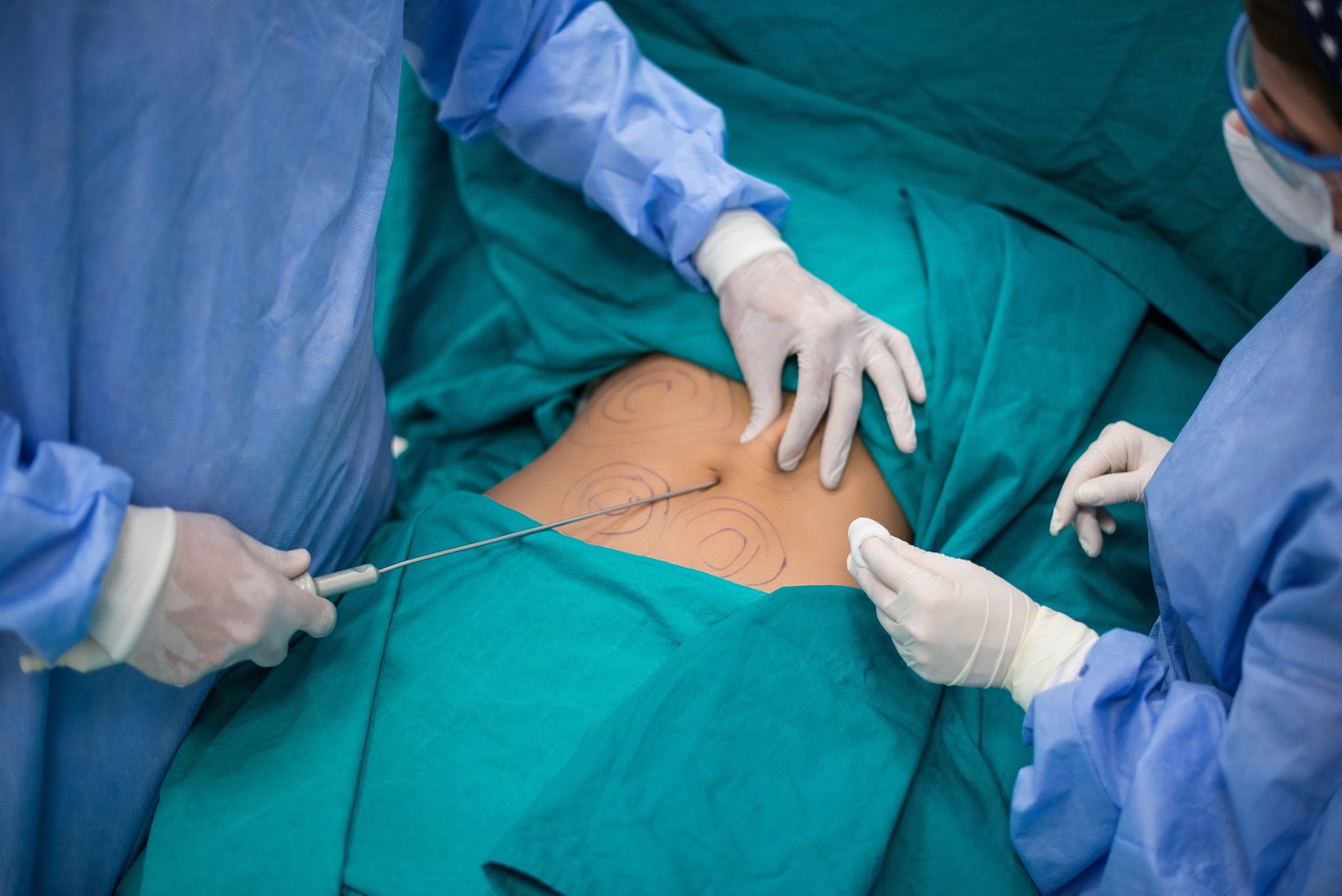 Woman having liposuction