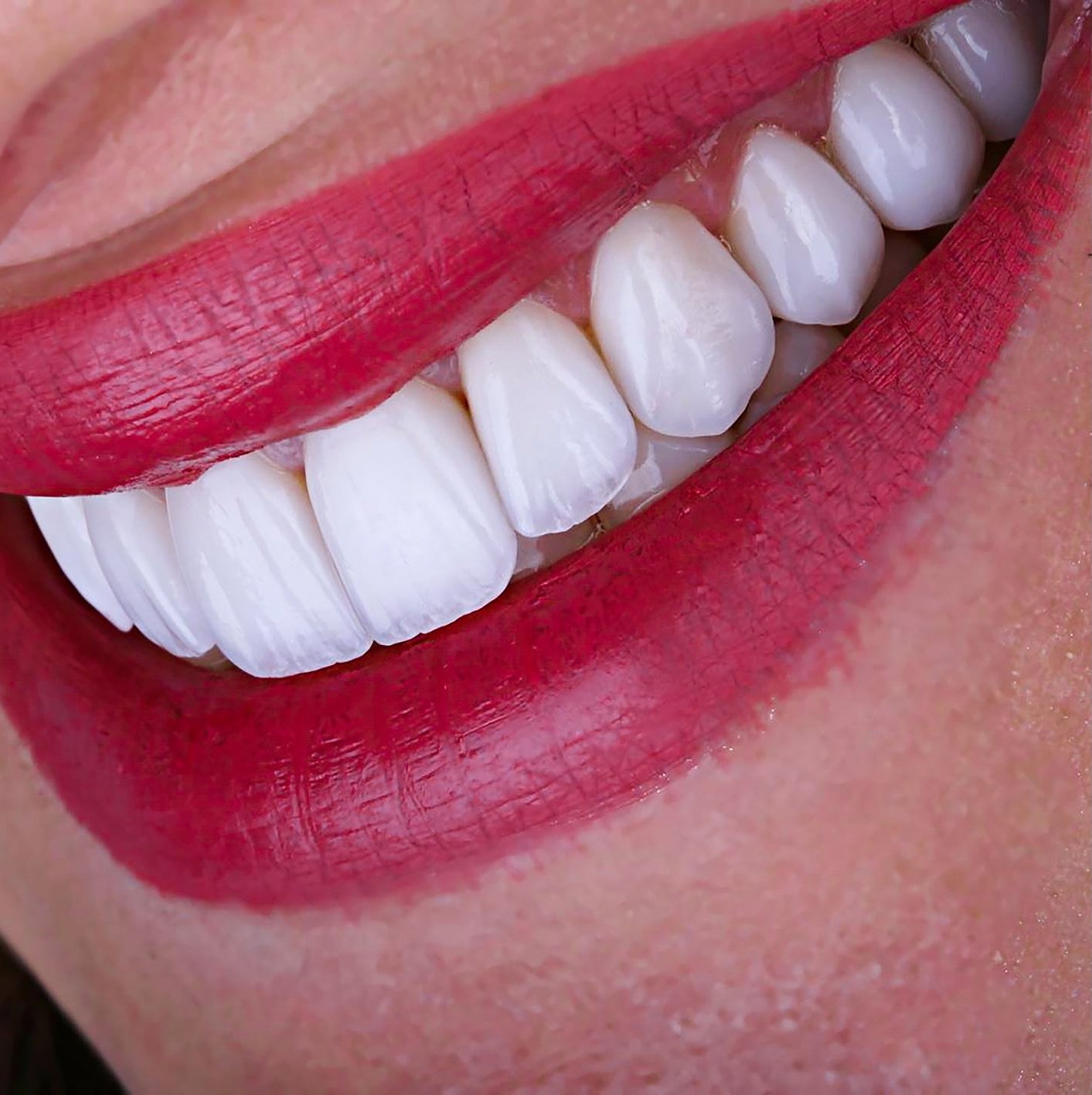 full mought emax press ceramic veneers